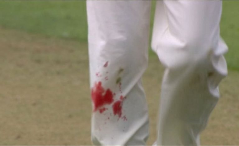 ENG vs IND: James Anderson continues to bowl with blood on his leg in the fourth Test